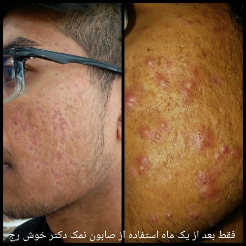 پک لایه بردار و رفع جوش