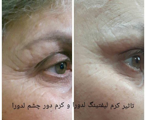 کرم رفع تیرگی دور چشم